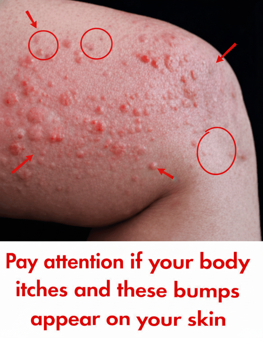 OMG! Why Are Hives Attacking Your Skin Out of Nowhere? The Sneaky Triggers You'd NEVER Guess!