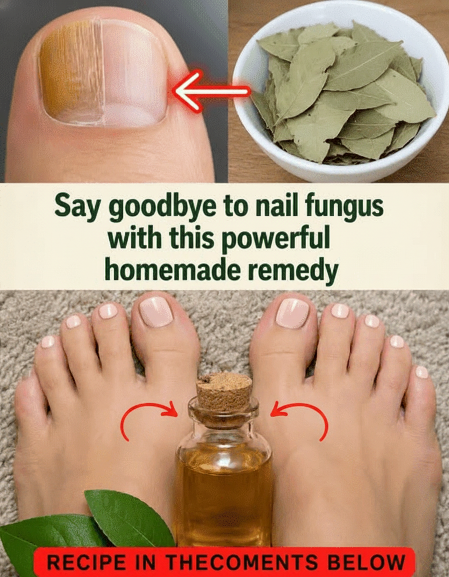 Kick Nail Fungus to the Curb: This Bay Leaf Oil Hack is a Game-Changer!